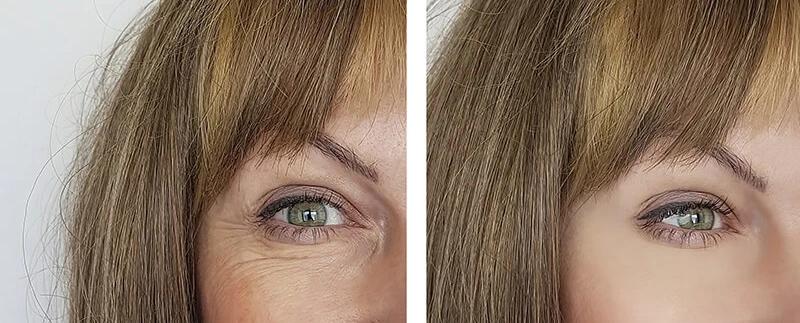 Wrinkle cream around the eyes3